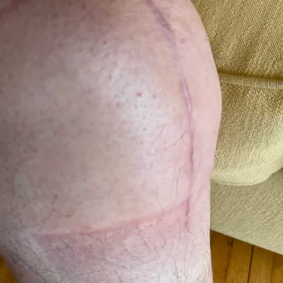 Full Knee Replacement - 4 Months Post-surgery